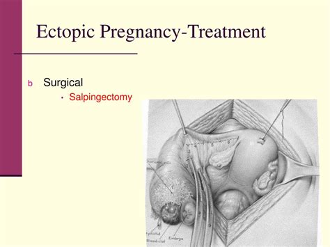 Ppt Ectopic Pregnancy Powerpoint Presentation Free Download Id 6916819