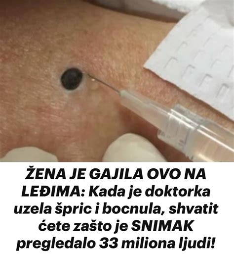 ŽENA JE GAJILA OVO NA LEĐIMA Kada je doktorka uzela špric i bocnula