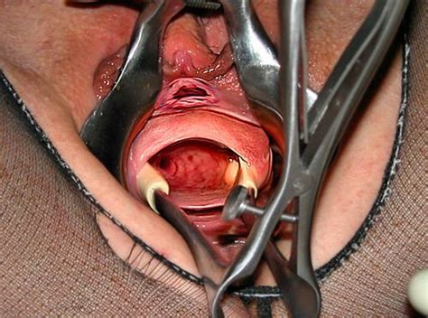 Pregnant Prolapse Porn Telegraph