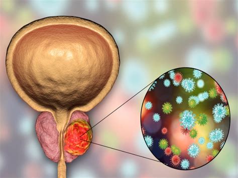 Que Es El Cancer De Prostata