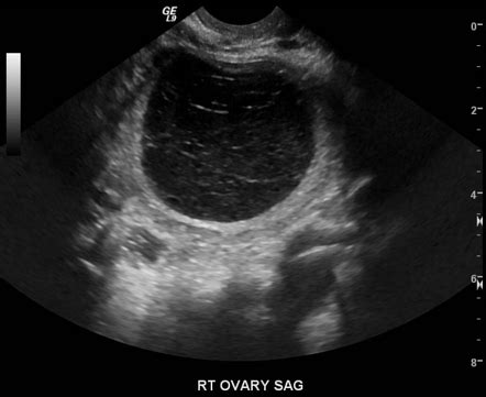 Hemorrhagic Ovarian Cyst Radiology Case Radiopaedia Org