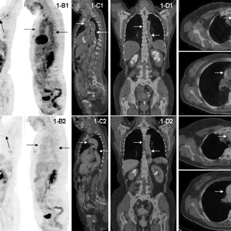 18 F Fluorodeoxyglucose Positron Emission Tomography Computed