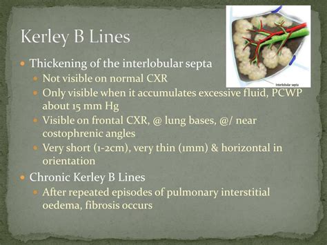heart failure  powerpoint    id