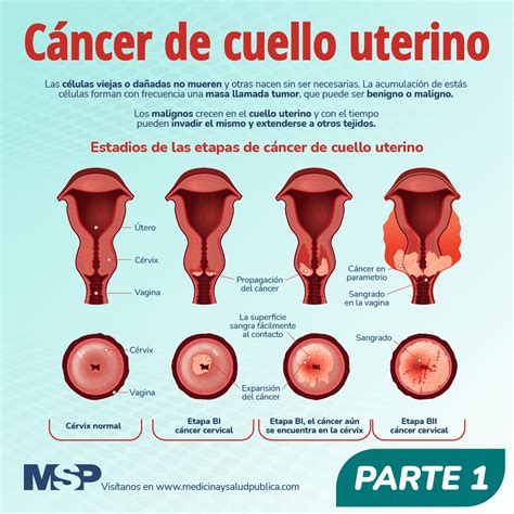 C Ncer De Cuello Uterino Infograf A