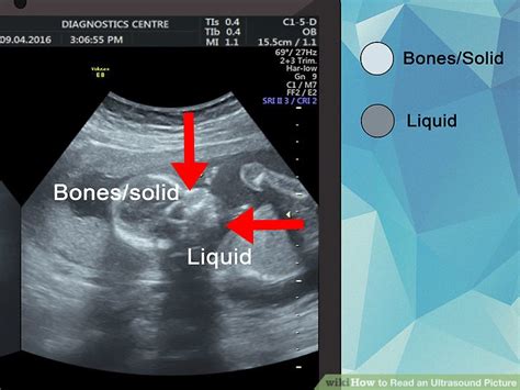 How To Read An Ultrasound Picture 9 Steps With Pictures