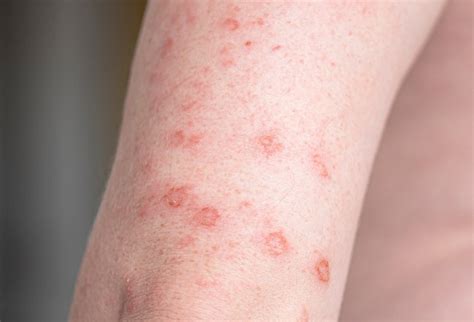 Wajib Tahu Ini Dia Berbagai Ciri Ciri Hiv Pada Kulit Yang Wajib Diwaspadai