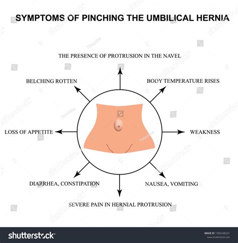 Symptoms Pinching Umbilical Hernia Infographics Vector 스톡 벡터 로열티 프리