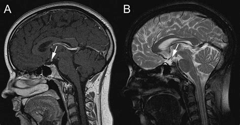 Teaching Neuroimages Ectopic Posterior Pituitary Neurology