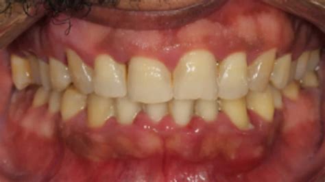 Gingival hypertrophy causes, symptoms, diagnosis & treatment