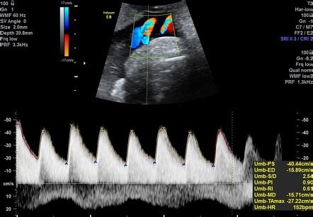 Umbilical Artery Doppler