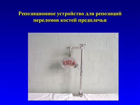 Общие принципы лечения переломов - презентация онлайн