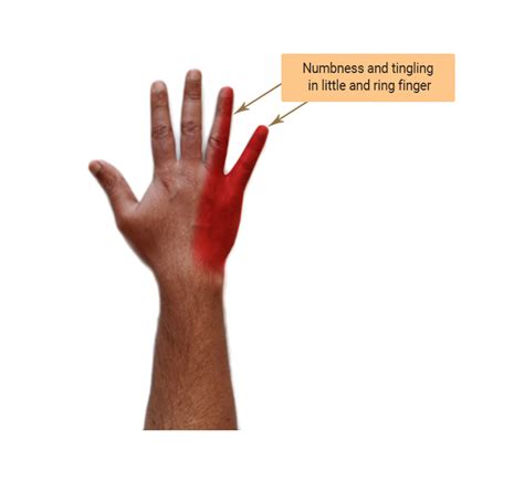 Cubital Tunnel Syndrome Test