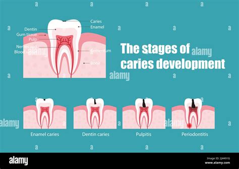 Etapas De La Caries Dental Fotografías E Imágenes De Alta Resolución