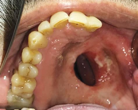 Prosthetic Rehabilitation Of An Acquired Maxillary Defect With