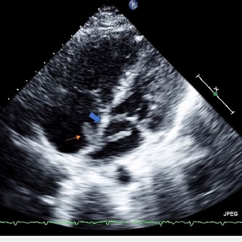 Two Dimensional Transthoracic Echocardiogram With Color Flow And