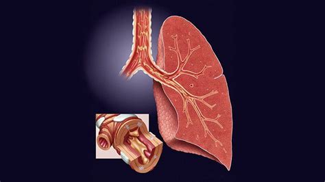 Chronic Bronchitis and COPD | Everyday Health