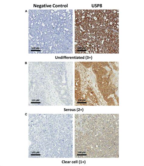 Immunohistochemical Evaluation Of Usp In Ovarian Carcinoma Specimens