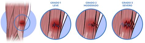 Desgarro Muscular Clínica MEDS