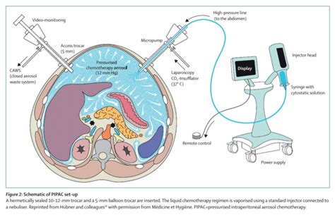 Tratamento Quimioterapia Pressurizada Intra Peritoneal