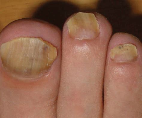 Onychomycosis Causes Clinical Appearance And Onychomycosis Treatment