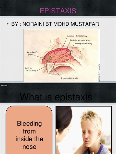 PDF Causes Of Epistaxis DOKUMEN TIPS