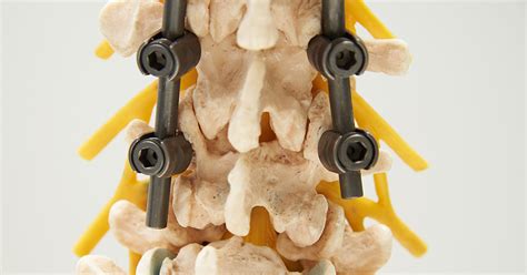 Ctnav Technique Increases Accuracy Of Pedicle Screw Placement Compared