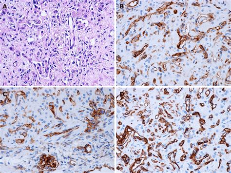 Hepatic Epithelioid Hemangioendothelioma Pathological Findings A Download Scientific Diagram