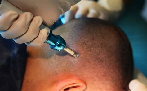 Micro FUE Sapphire Haar Transplantation Innovation Hair Transplant