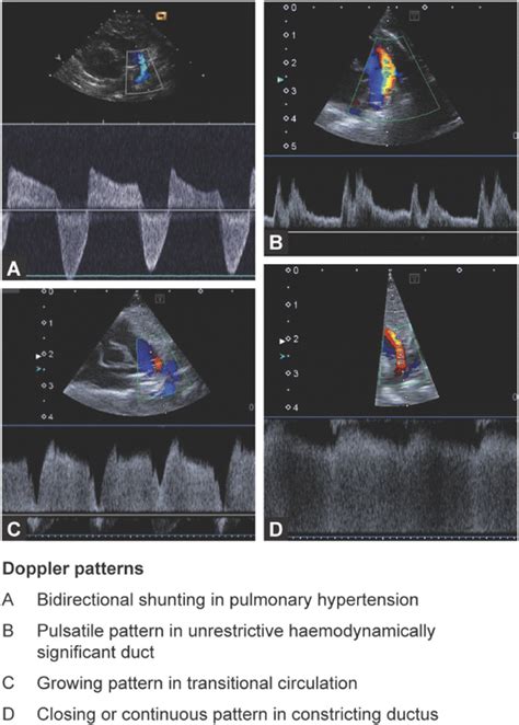 Doppler Flow Patterns Across Ductus Arteriosus Download Scientific Diagram