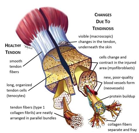 Healthy Tendon V Tendinosis Labeled Unc Orthopaedics