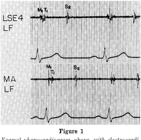 Figure 1 From The Apical First Heart Sound As An Aid In The Diagnosis Of Atrial Septal Defect