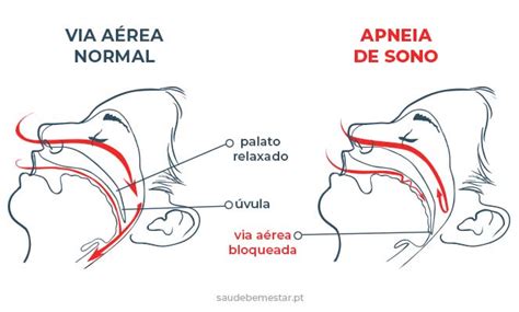 Apn Ia Do Sono Pode Matar Entenda Como A Doen A Pode Ser Fatal A