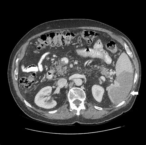 [figure Axial Slice Of An Enhanced ] Statpearls Ncbi Bookshelf