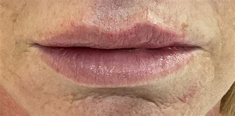 Lip Filler Swelling Stages The Timeline Longevita