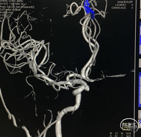 颅内动脉瘤微导管塑形演义（六） 脑医汇 神外资讯 神介资讯