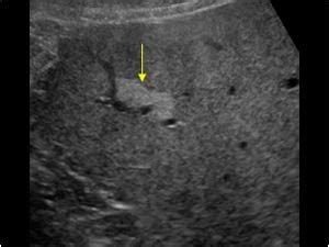 Abdomen and retroperitoneum | 1.1 Liver : Case 1.1.11 Fatty liver and focal sparing | Ultrasound ...