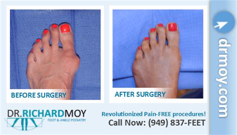 Dr Richard Moy Dpm Painless Bunion Surgery Board Certified Surgeon