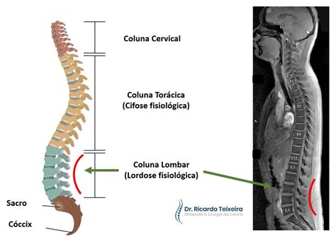 Lordose Lombar Dr Ricardo Teixeira Especialista