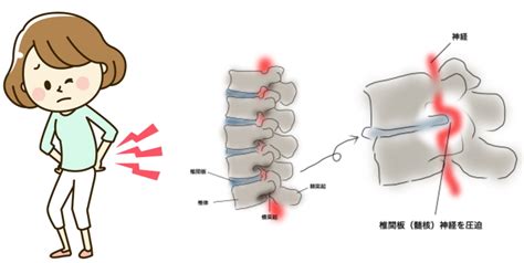 腰椎椎間板ヘルニア のぞみ整形外科クリニック西条 広島県東広島市西条町の整形外科クリニック