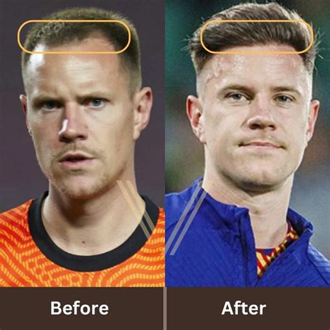 Ter Stegen S Hair Transplant Before And After Transformation