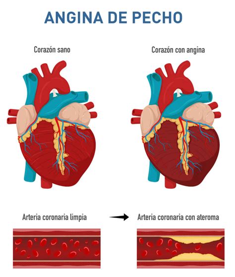 Angina de pecho Policlínico San Miguel