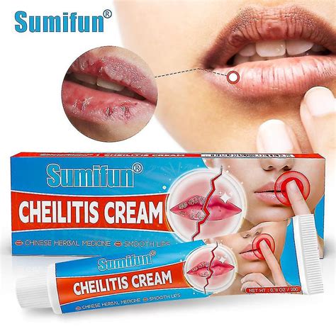 Angular Cheilitis Treatment