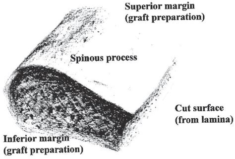 Figure From Clinical And Radiological Outcomes Of Segmental Spinal