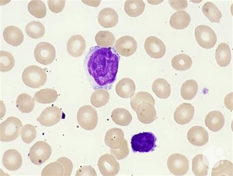 Sezary Cell