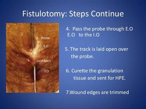 Fissure and fistula