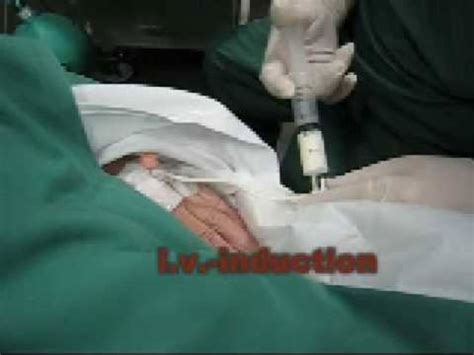 Ambu AuraOnce Laryngeal Mask Insertion In Real Patient Ambu External