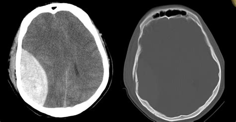 Trauma Head CT Interpretation – EMCAGE