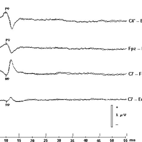 Electroencephalography (EEG) shows the isoelectric line in brain ...