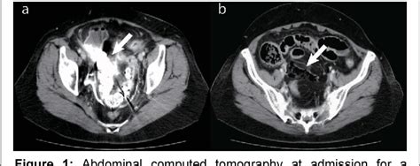 Figure From Two Cases With Perforation Of The Large Intestine After