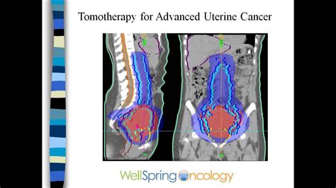 Radiation And Endometrial Cancer Youtube